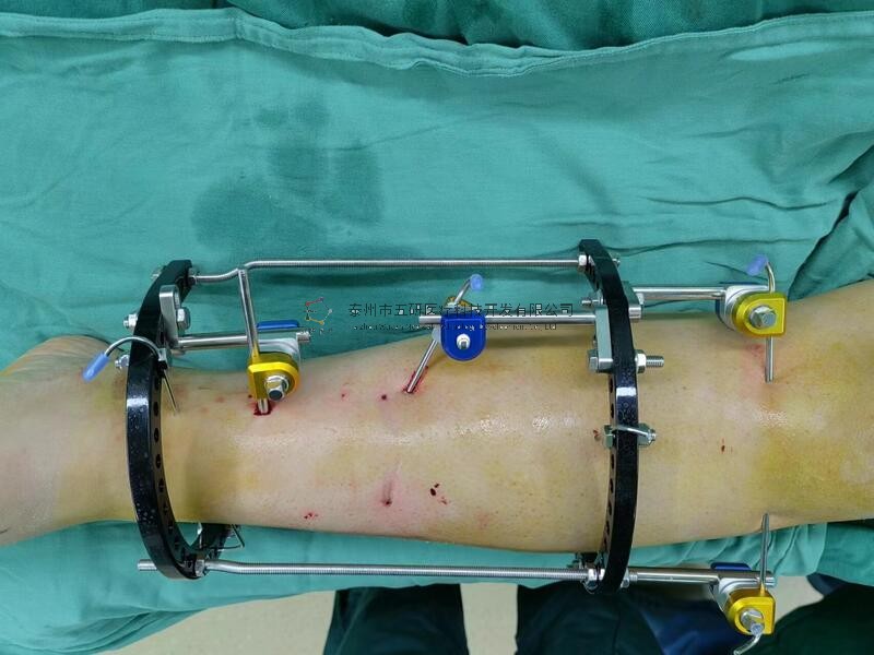 【南陽市中醫(yī)院】不開刀治骨折病例分享